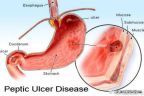 পাকস্থলীর ক্ষত সারানোর ঘরোয়া চিকিৎসা