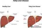 লিভারের ফ্যাট কমানোর ঘরোয়া ৬ উপায়