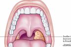 টনসিল থেকে দূরে থাকার উপায়